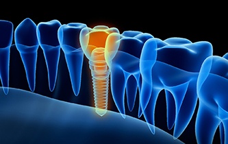 a computer illustration that looks like an X-ray showing a implant-retained dental crown