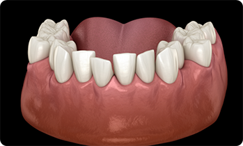 Illustration of crowded teeth in lower arch