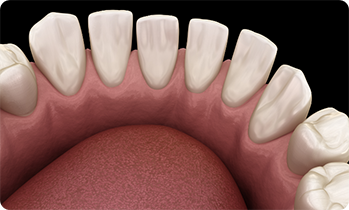 Illustration of teeth spaced too far apart