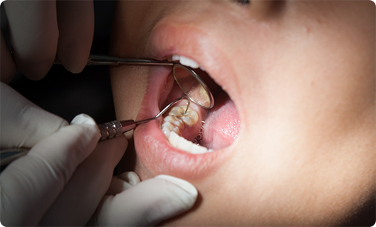 Examining patients teeth with a dental mirror