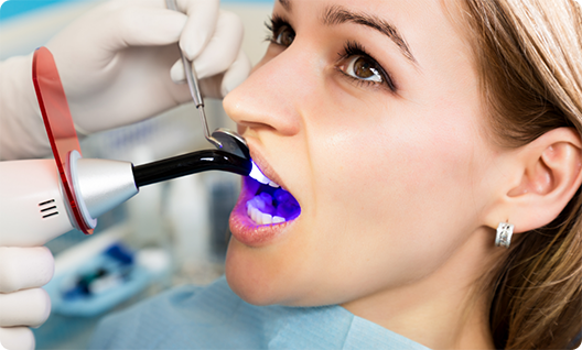 Blonde woman holding mouth open for cosmetic dental bonding