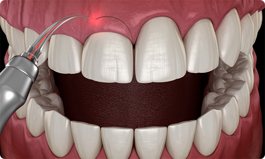 Illustration of gums being treated with laser