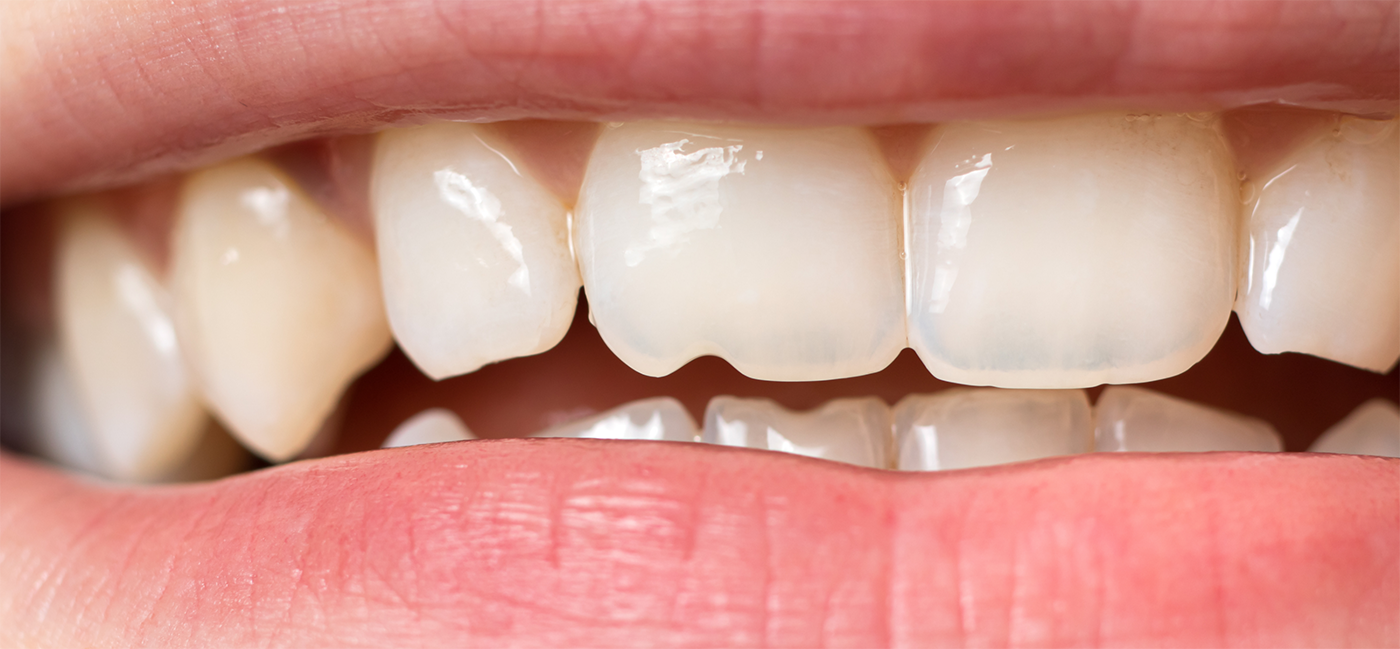 10 Laws Of cost of tooth veneers