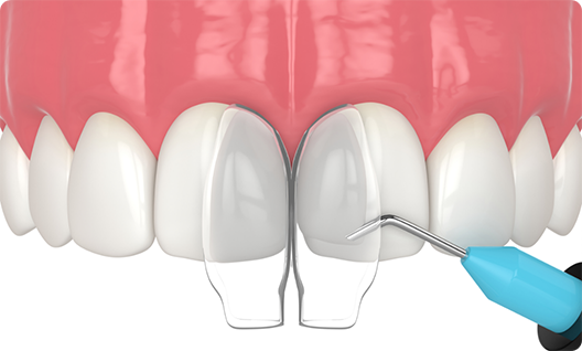 Illustration of teeth receiving dental bonding