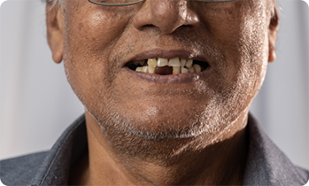 Close up of mans mouth with multiple missing teeth