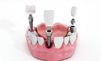 Illustration of dental implants and crowns being inserted into jaw