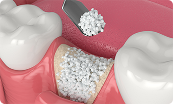 Illustration of bone grafting being performed for lower jaw