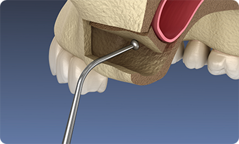 Illustration of sinus lift being performed