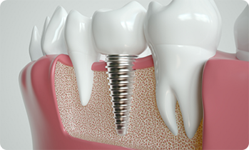 Model of dental implant in gums