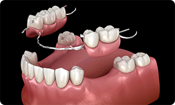 Illustration of partial dentures being used to replace lower teeth