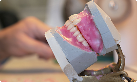 Dentures in plaster being crafted