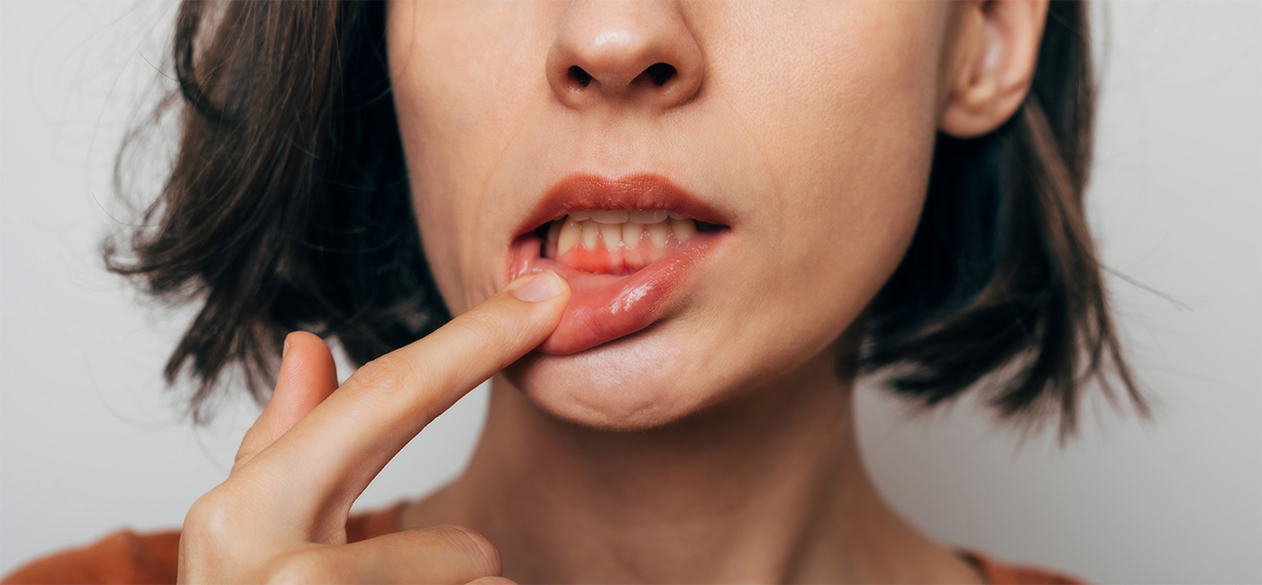 Woman pulling down lip and showing inflamed gums