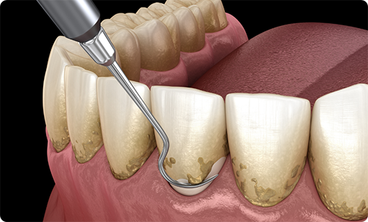 Illustration of scaling and root planing for gum disease treatment in Little Rock