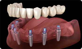 Illustration of dentures being attached to dental implant posts