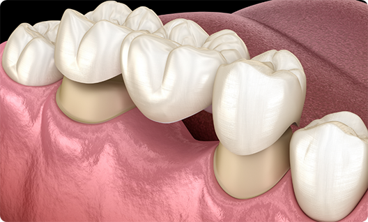 Illustration of dental bridge being placed on teeth