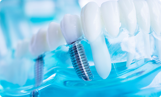 Dental implants in a plastic tray