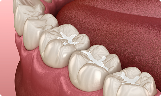 Illustration of multiple teeth with dental sealants