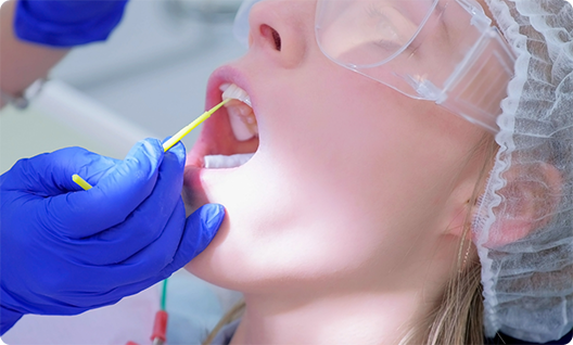 Patient with mouth open having fluoride applied to teeth