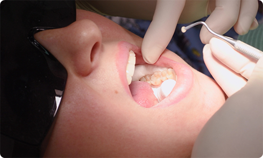 Patient holding mouth open to have filling placed