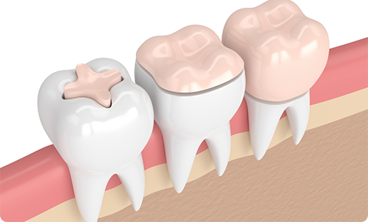 Teeth repaired with different forms of restorative dentistry in Little Rock