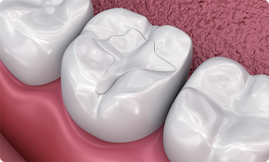 Illustration of teeth with tooth colored fillings