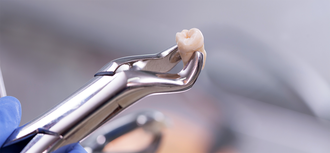 Close up of forceps holding tooth after tooth extraction in Little Rock