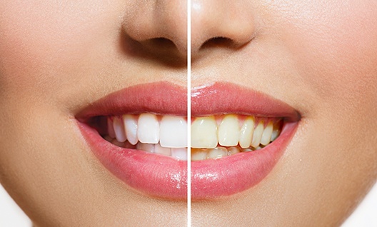 Closeup of patient's smile before and after teeth whitening