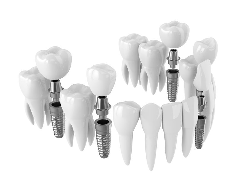 use-dental-insurance-for-dental-implants-little-rock-family-dental-care